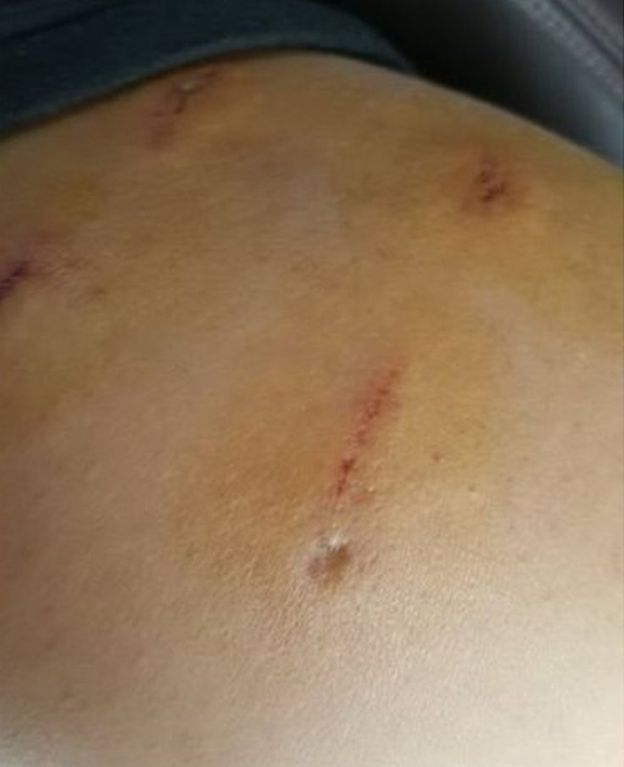 Bite marks on the man's left shoulder [Photo: Weibo]