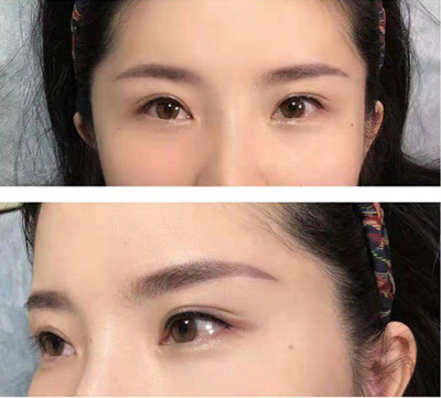 A patient who has just had eyebrow and eye liner tattoos. [Photo: China Plus]