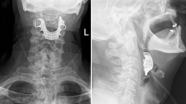 X-ray images show dentures stuck in the throat of a 72-year-old patient. [Photo: AP/BMJ]